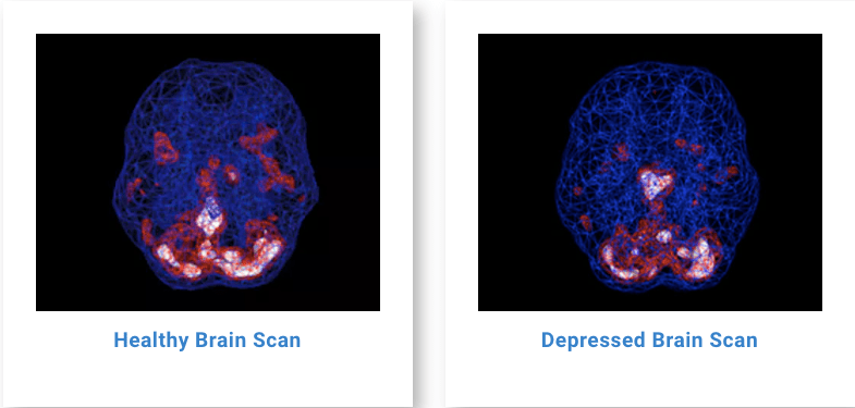 what does depression do to the brain